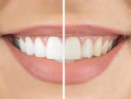 image-Teeth-Whitening-opt